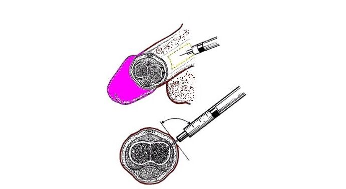 Inxeccións de vaselina para a ampliación do pene